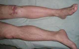 Воспаление костного мозга: возможные осложнения и способы лечения