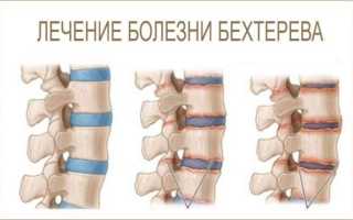 Болезнь бехтерева: причины, симптомы, классификация
