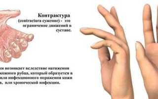Контрактура – это что? контрактура мышц: диагностика, лечение
