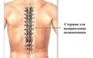 Кифоз грудного отдела позвоночника