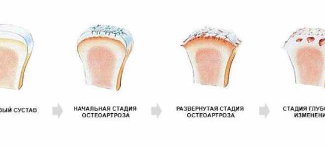 Остеопороз мыщелка локтевого сустава