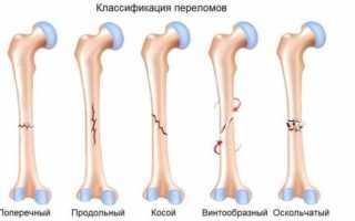 Изолированный перелом диафиза локтевой кости