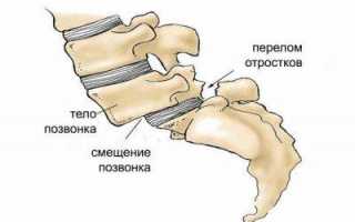 Спондилолистез шейного отдела позвоночника