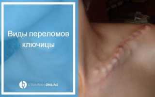 Перелом ключицы