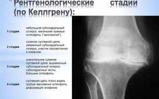 Субхондральный склероз замыкательных пластинок шейного отдела