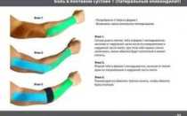 Кинезиотейпирование при эпикондилите локтевого сустава