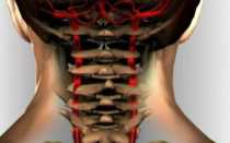 Дисторсия шейного отдела