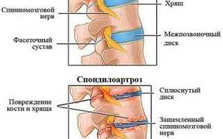 Инвалидность при спондилоартрозе