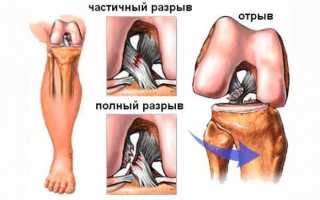 Киста беккера. у кого было?