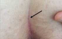 Иссечение копчикового хода