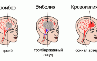 Клиническая картина фиксированного спинного мозга