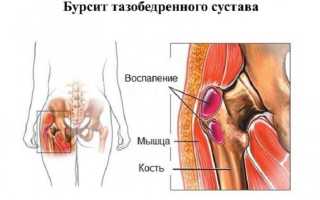 Как лечить коксартроз на любой стадии